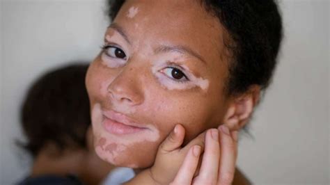 How To Detect Vitiligo Know Signs And Symptoms Of Skin Condition That Causes Pale White Patches