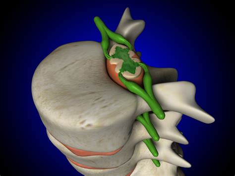 Living With Arachnoiditis - Causes, Symptoms