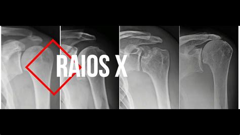 Radiografia Pa E Perfil De T Rax Youtube