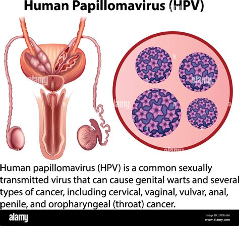 Virus del papiloma humano con ilustración de explicación Imagen Vector