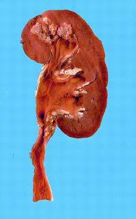 Renal Fellow Network Renal TB