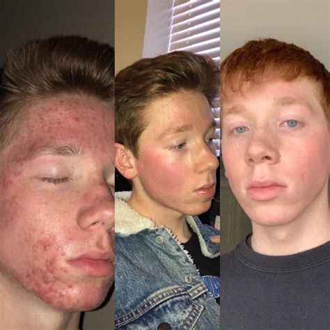 Before During After Accutane Might Turn You Into An Eboy Scrolller