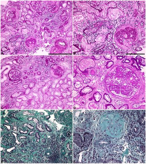 Representative Renal Histology Renal Biopsy Specimens Of Patients With