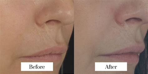 Rf Microneedling Brisbane Jade Cosmetic Clinic