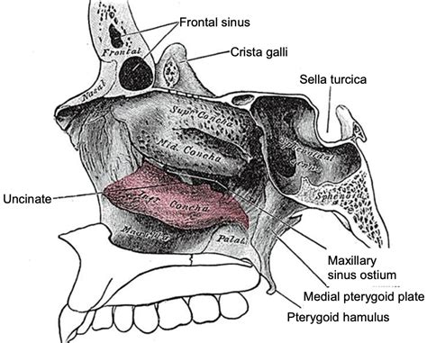 Caldwell Luc Antrostom A Radical Fosa Canina Y Punci N Meatal