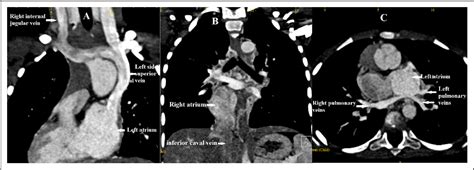 Figure From Identifying Anomalies Of Systemic Venous Drainage