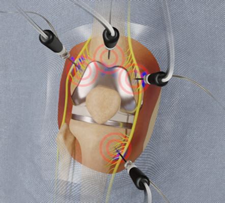 Can Cooled Rf Ablation Relieve Post Knee Replacement Pain