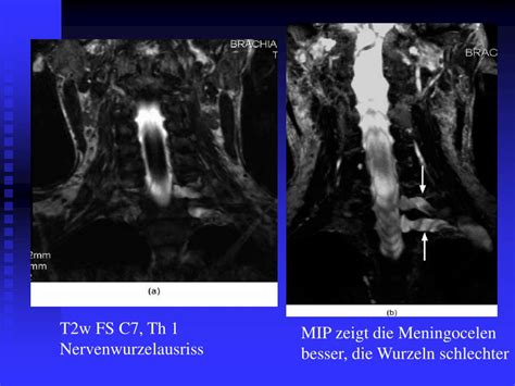 PPT MRT bei Plexus brachialis Läsionen PowerPoint Presentation free