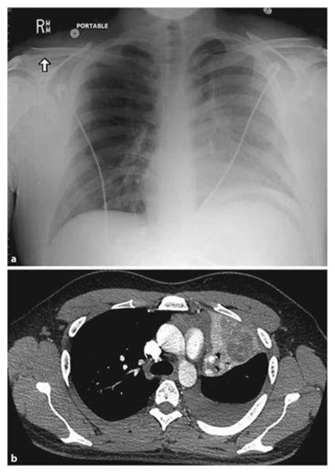 Chest X Ray A And Chest Ct B At Diagnosis Showing Left Lower Lobe Download Scientific