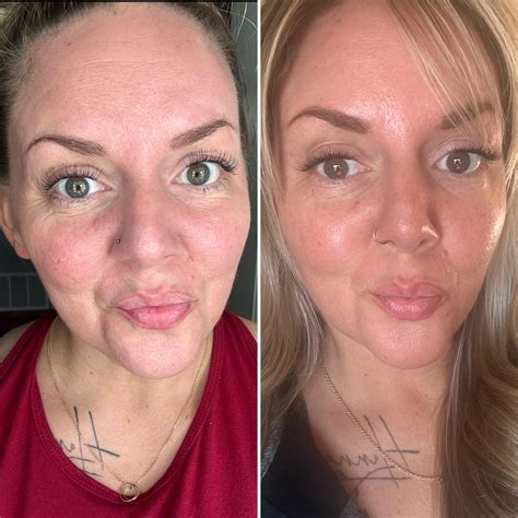 3 Months On Tret For Anti Aging R Tretinoin