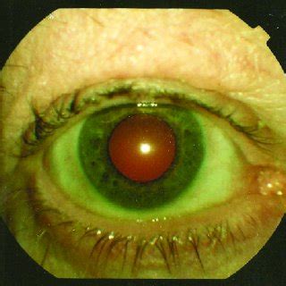 Most common differential diagnosis of hypopyon, anterior uveitis and... | Download Table