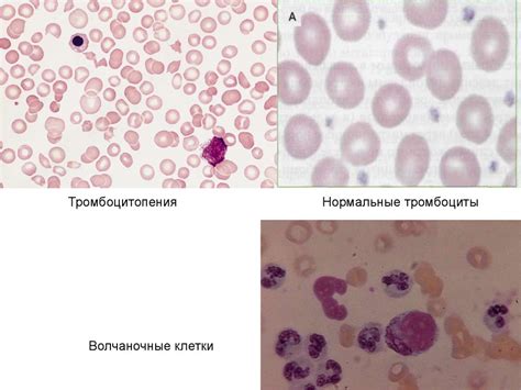 Особенности гемограммы при воспалительных и системных заболеваниях ...