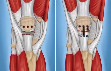 Patellar Tendon Tear Orthoinfo Aaos Quadriceps Tendonitis Tendon Tear Knee Tendonitis