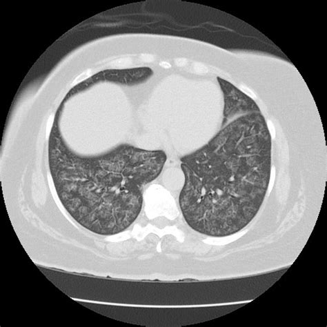 Radiopaedia Case Pulmonary Alveolar Proteinosis Id Study