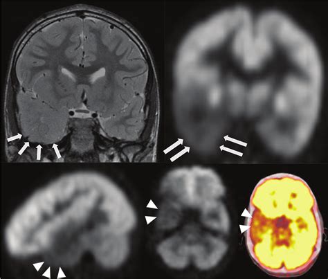 Brain Mri In Patient With Focal Cortical Dysplasia Visualized As