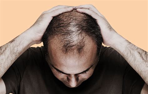 Hypothyroidism Hair Loss Men