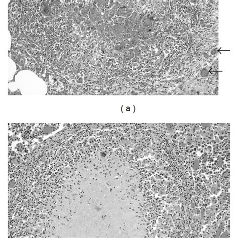 Histology Of Lung A And Pulmonary Lymph Node B Lesions Typical