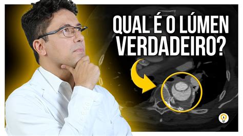 Como Identificar DISSECÇÃO DE AORTA em ANGIOTOMOGRAFIA YouTube