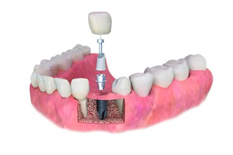 Implantes Y Pr Tesis Dentales Dr Smile