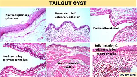 Epidermoid Cyst Histology