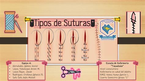 Tipos De Sutura Odontologia BRAINCP