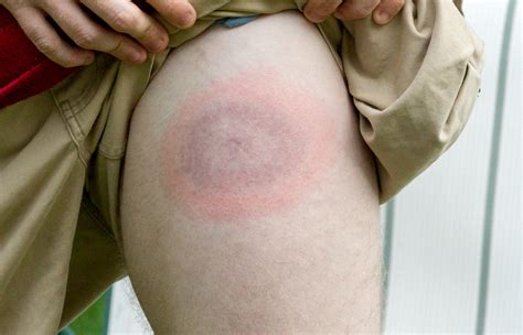 Porter County Ticks Lyme Disease