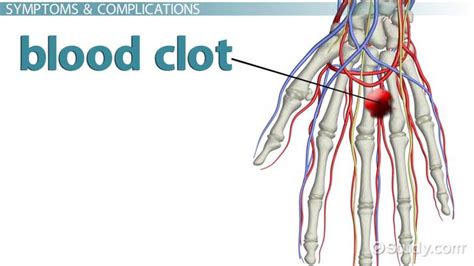 Blood Clot in the Hand: Symptoms, Signs & Treatment - Lesson | Study.com