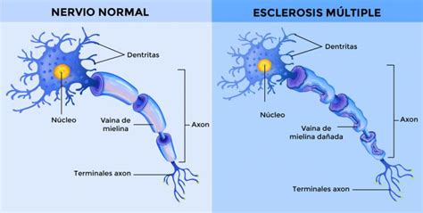 Esclerosis Múltiple Qué Es Y Causas