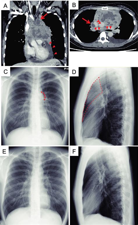 Radiological Findings Of The Anterior Mediastinal Tumor Chest Abdominal