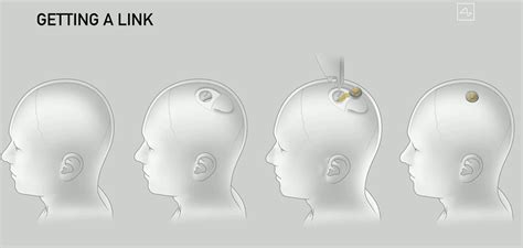 Neuralink implant to connect the brain with computers