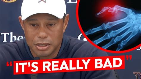 Tiger Woods Injury Could Be Career Ending Youtube