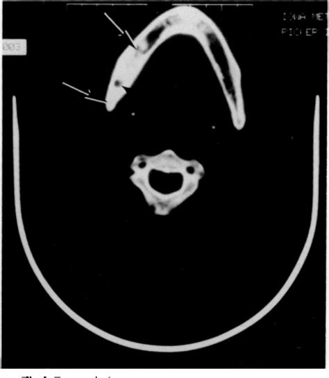 Figure 2 From Osteomyelitis Of The Mandible Simulating A Stafne Mandibular Cortical Defect