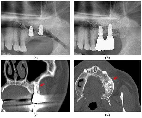 Applied Sciences Free Full Text Minimally Invasive Lateral Approach Through Circular Window