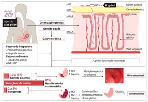 Gastrite Afeta O Intestino - Gastrites - IGASTROPED