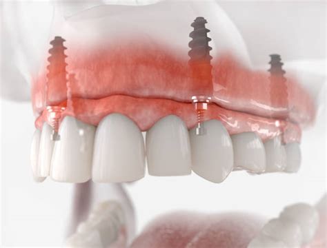 What Are The Advantages Of All On 4 Dental Implants National Dental