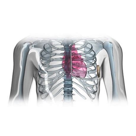 Emblem Mri S Icd System Subcutaneous Implantable Defibrillator