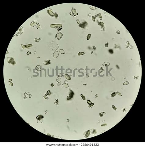 Microscopic Image Showing Calcium Oxalate Monohydrate Stock Photo