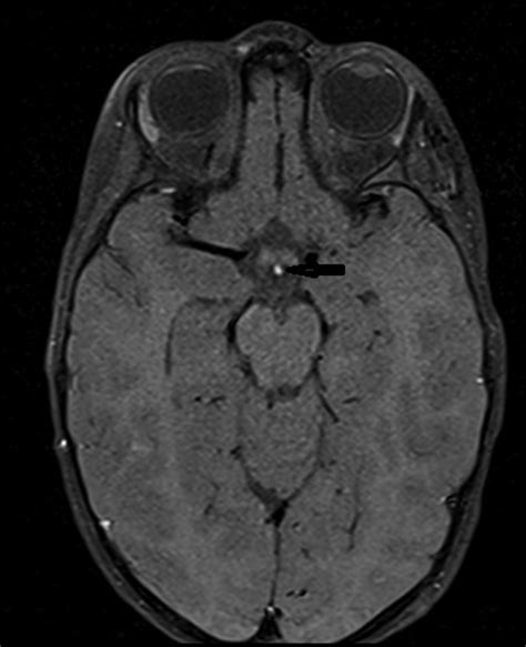 The T1 Fat Sat Weighted Magnetic Resonance Images On Axial Plane The