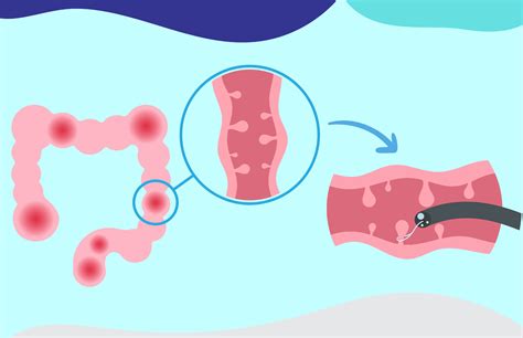 Endoscopic Removal of Polyps | Digestive Health