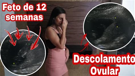 Descolamento Ovular Youtube