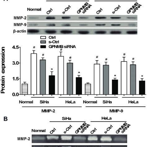 A Expression Of Glycoprotein Nonmetastatic Melanoma Protein B GPNMB