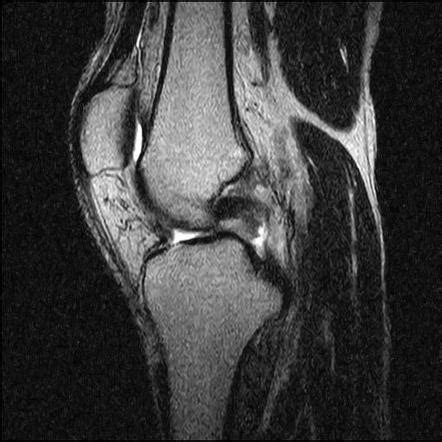 Posterior Cruciate Ligament Tear Image Radiopaedia Org