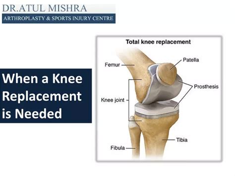 Ppt Best Knee Replacement Surgery In Delhi Ncr Total Knee Surgeon