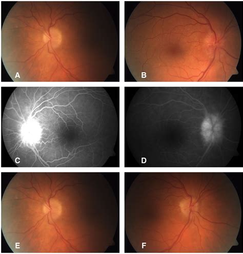 Optic Neuropathy Secondary To Perhexiline And Amiodarone Bmj Case Reports