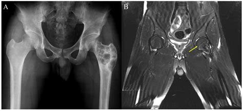 Characteristics Of Giant Cell Tumor Of The Bone In Pediatric Patients Our 18 Year Single