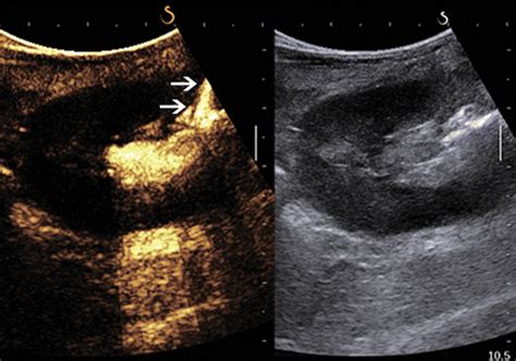 Nephrostomy Tube Ultrasound