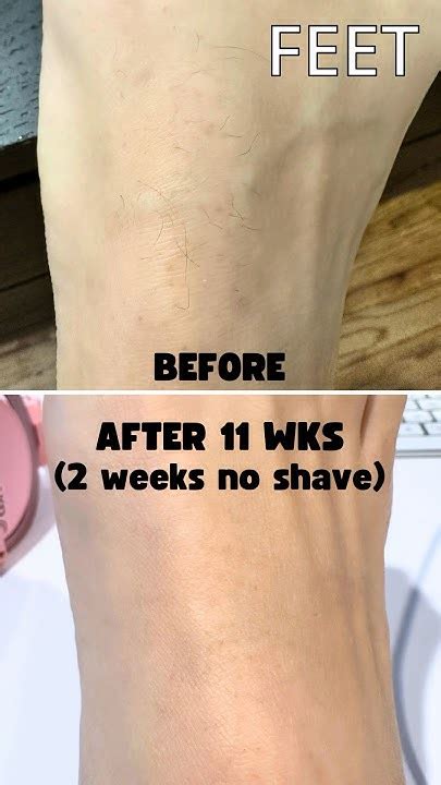 Ulike Ipl Hair Removal After 11 Weeks Youtube