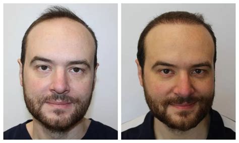 Affordable Fut Hair Transplant In Riyadh Saudi Arabia