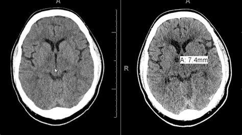 Porencephalic Cyst Mri