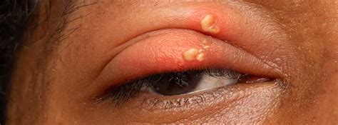 Eye Herpes Symptoms Treatment Causes Feel Good Contacts